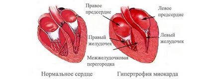 axa deviație schematică inima, poziția verticală și orizontală
