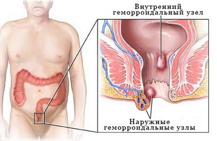 Hemoroizi cauze simptome de tratament