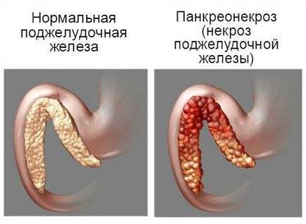 Cum doare pancreasul la om principalele simptome