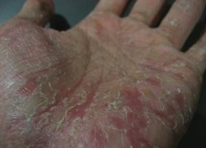 Cum de a trata eczeme pe mâinile unor medicamente eficiente și remedii populare