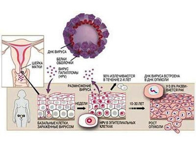 Cum tratam papilomavirusului metodele majore de tratament si modul de papillomavirus infecției virale (HPV)