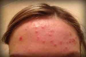 Cum de a trata acnee pe frunte - tratament pentru acnee - Articole Directory - cum să fie frumoasă