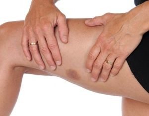 Cum de a trata venele și vasele de sânge la nivelul picioarelor