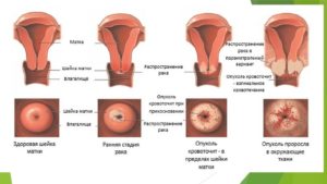 Cum de a trata papilomavirus uman cele mai eficiente metode