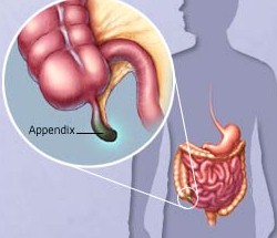Cum de a determina apendicita 4 etape,