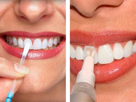 Cum de a albi dintii în condiții de acasă rețete