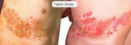 Ce este herpesul zoster au fotografii simptomele bolii umane
