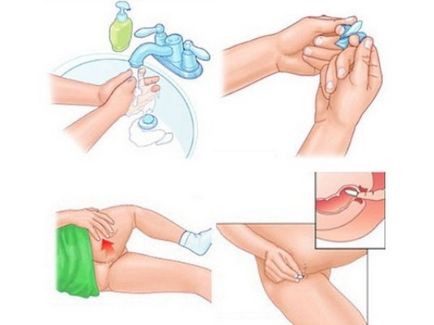 instrucțiuni lumânare Ketonal pentru utilizare în ginecologie