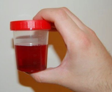 Sânge în urina femeilor, aceasta poate fi cauze, tratament