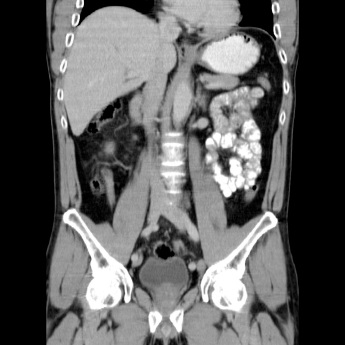 CT abdominal care arată prepararea CT cu substanță de contrast și preț