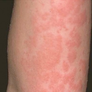 Tratamentul si simptome de alergie la praf de spălat într-un copil - totul despre alergii