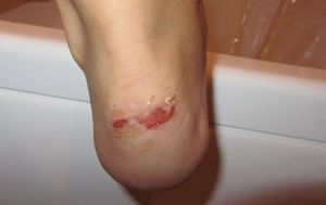 Tratamentul de vezicule izbucni pe picioare