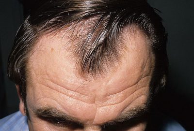 Tratamentul chelie in diagnosticul barbati si eficiente metode de a face cu alopecie