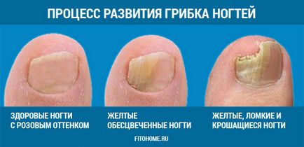 Tratamentul unghiilor ciuperca 2 luni 1 h (onicomicoza)