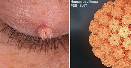 remedii populare HPV Tratamentul