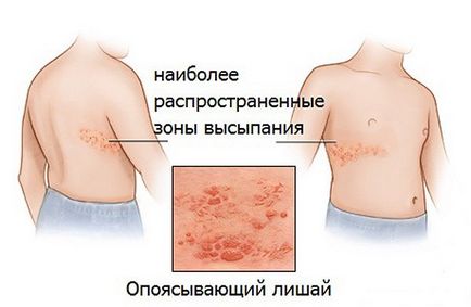 Priveze forme de persoană, cauze, simptome, tratament