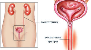 Urina cu sânge în cauzele femei