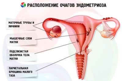 Urina cu sânge în cauzele femei