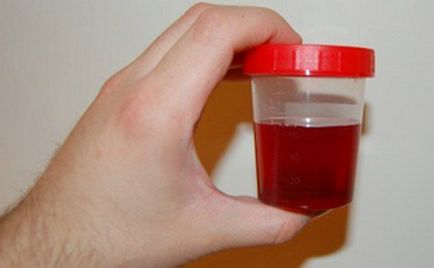 Urina cu sânge la femei provoacă sânge atunci când urinat