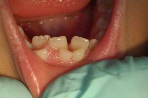 Dinții de lapte la copii - pierdere de circuit