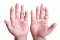remedii populare pentru eczeme pe maini