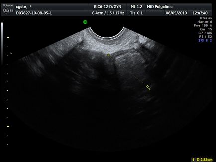 Nu lotsiruetsja că este - nu au vazut ovar pe ultrasunete, șablon