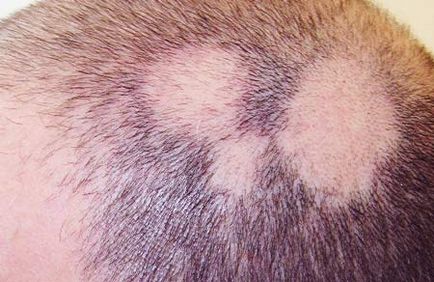 Alopecia areata cauze la barbati, tratament