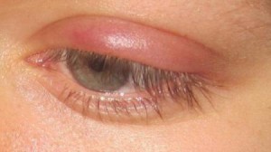 Ochii umflate pleoapei superioare și provoacă durere, ce să facă (review-uri)