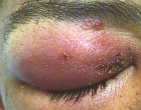 Umflarea pleoapelor - cauze si tratament (foto)