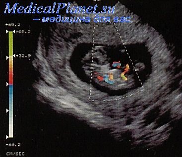 Complicațiile sarcinii in septuri uterin