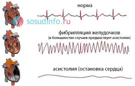 stop cardiac, primul ajutor asistola, cauze, tratament