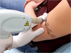 Despre tatuaje dintr-un punct de vedere medical
