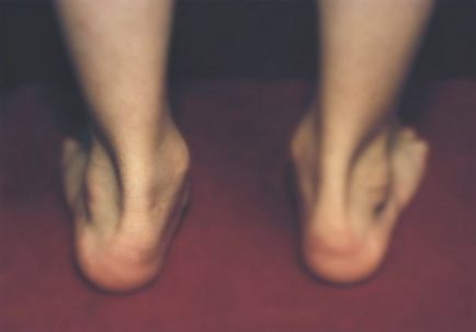 De ce picioare doare cauza dureri în partea dreaptă și piciorul stâng