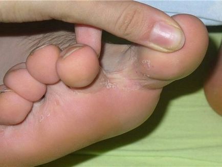 De ce senzația de mâncărime degetele de la picioare - să fie sănătos