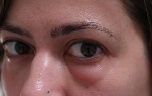 De ce ochii au început să se umfle, și ce să facă cauzele umflarea unui ochi, și eliminarea de edem