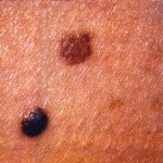 Care sunt cauzele birthmarks