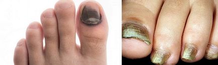 De ce întuneca unghiile de la picioare cum să trateze