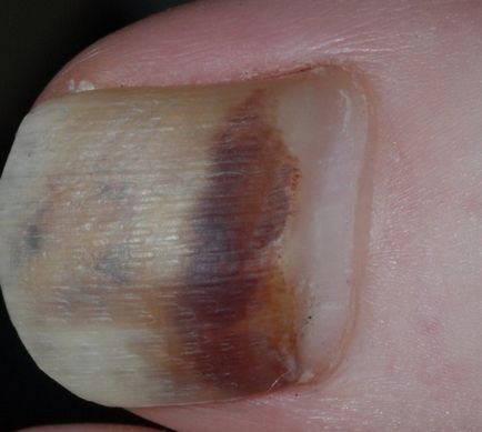unghii înnegrit privind cauzele și tratamentul picioarelor
