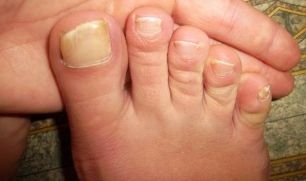unghii înnegrit privind cauzele și tratamentul picioarelor