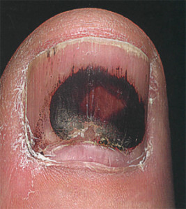 unghie înnegrită pe un picior - cauze și consecințe