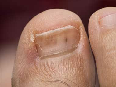 cuie întunecate pe degetul mare - cauze si tratament