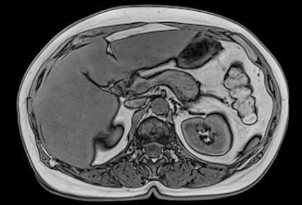 Efectuarea imagistica prin rezonanta magnetica a cavității abdominale