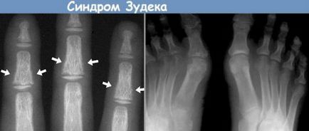 sindromul durerii regionale complexe după tratament radiații fractură de braț, fotografii