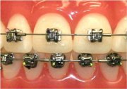 Cât de mult uzura aparat dentar - recomandări stomatologi