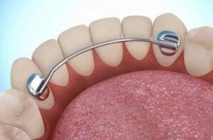 Cât de mult uzura aparat dentar - recomandări stomatologi