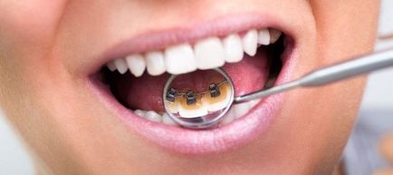 Cum de a purta aparat dentar pe dinți