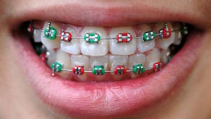 Cum să poarte bretele pe dinti pentru a alinia dinții