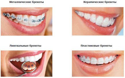 Cât de mult sunt bretele pe dinti de timpul de tratament