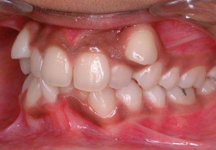 Cât timp ar trebui să poarte aparat dentar pentru a corecta o muscatura proasta