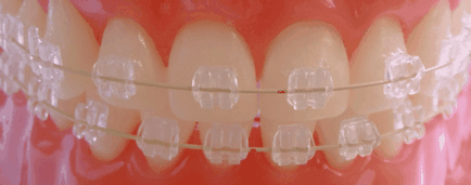 Cât timp ar trebui să poarte aparat dentar pentru a corecta o muscatura proasta